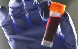 Исследователи установили связь между группой крови и вероятностью диабета 2 типа