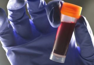 Дослідники встановили зв’язок між групою крові та ймовірністю діабету 2 типу